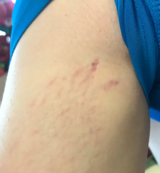 Bartonella tracks on arm